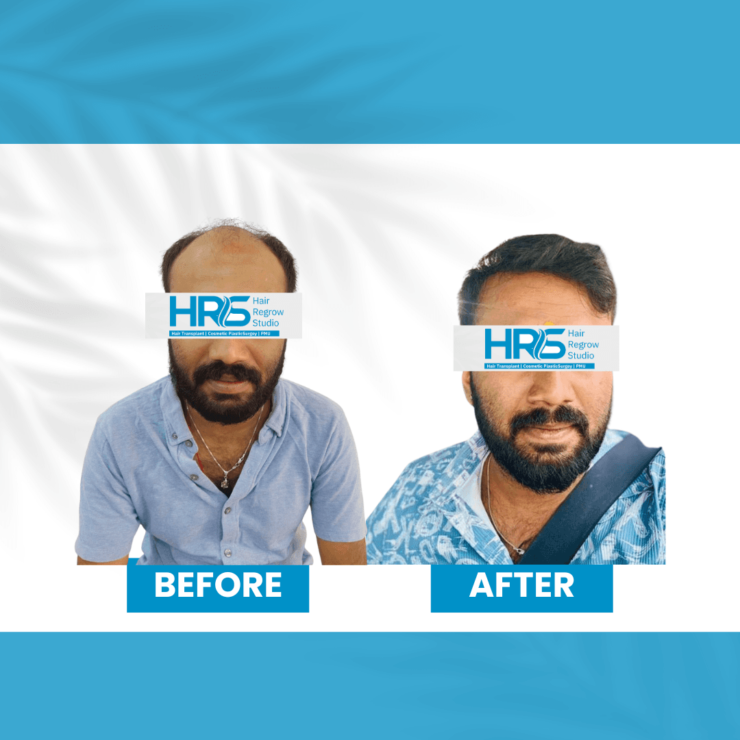 Hair restoration result — Patient 4