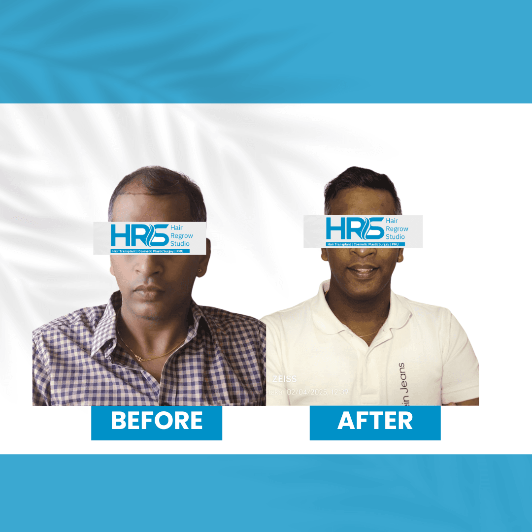 Hair restoration result — Patient 5