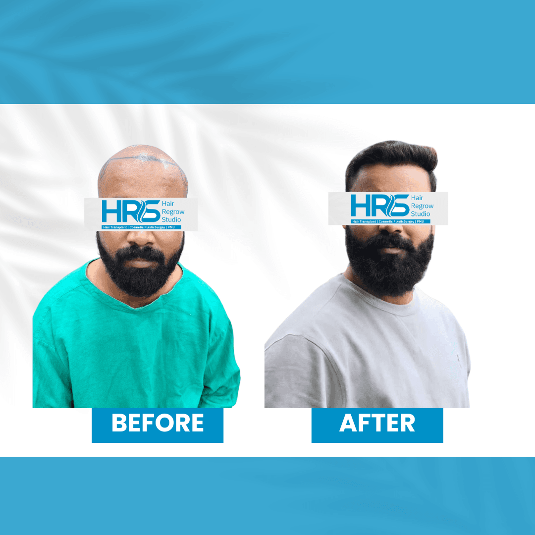 Hair restoration result — Patient 7