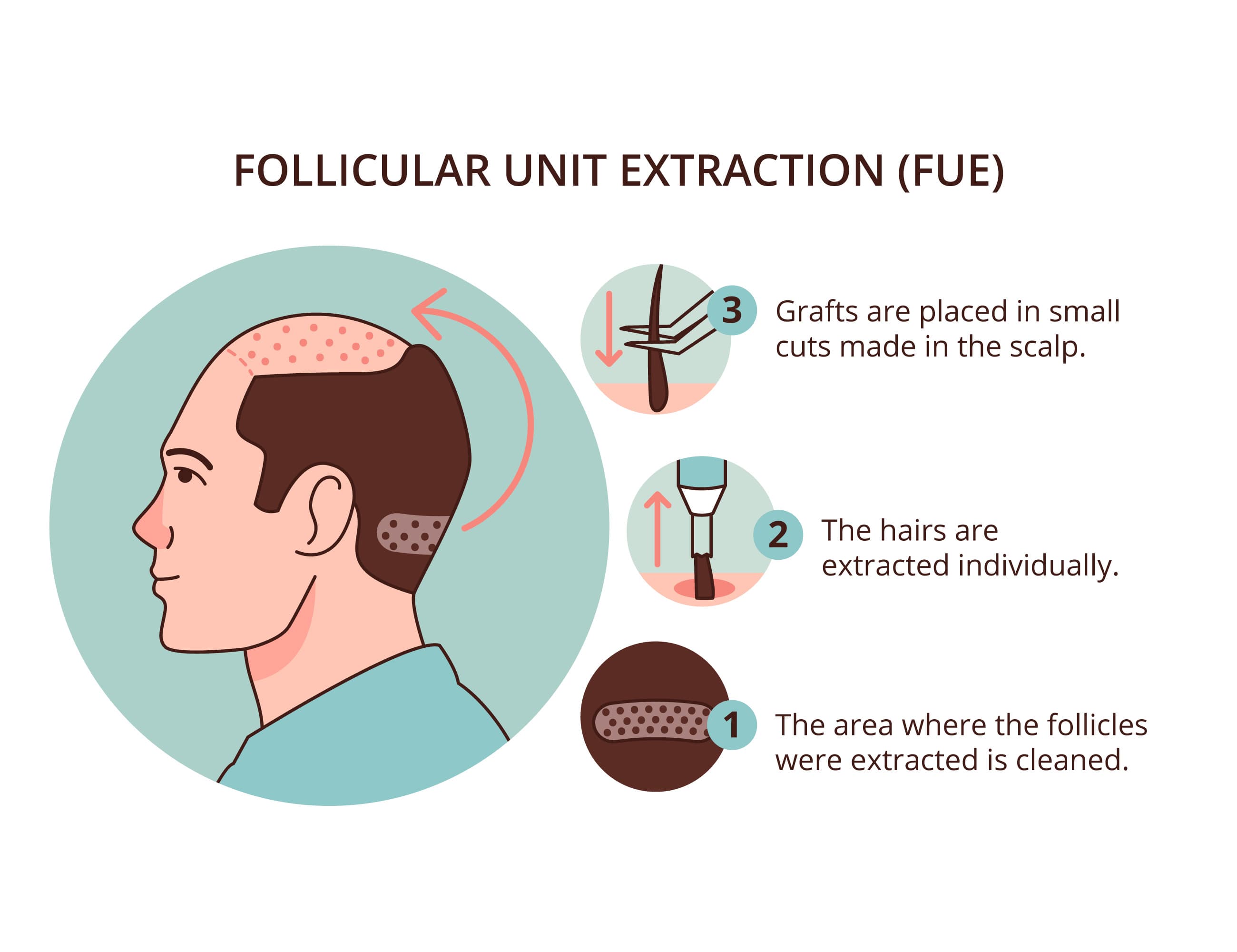 Follicular Unit Extraction (FUE)